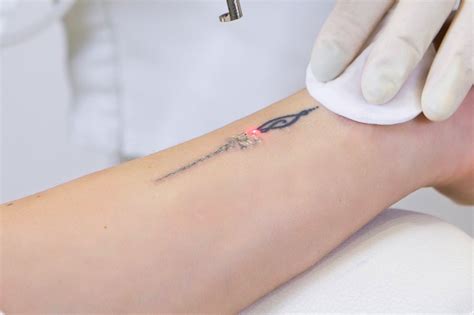 Laser tattoo. Things To Know About Laser tattoo. 